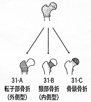 転子部骨折　頸部骨折　骨頭骨折