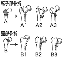 転子部骨折　頸部骨折