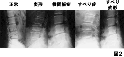 椎間板症 すべり症