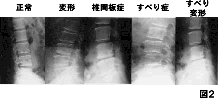 椎間板症　すべり症