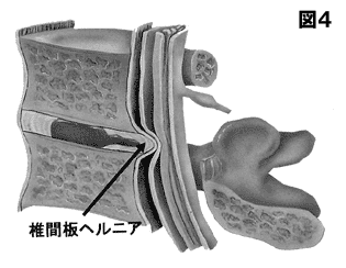 椎間板ヘルニア