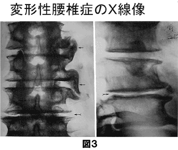 変形性腰椎症のX線像