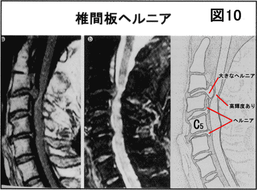 椎間板ヘルニア